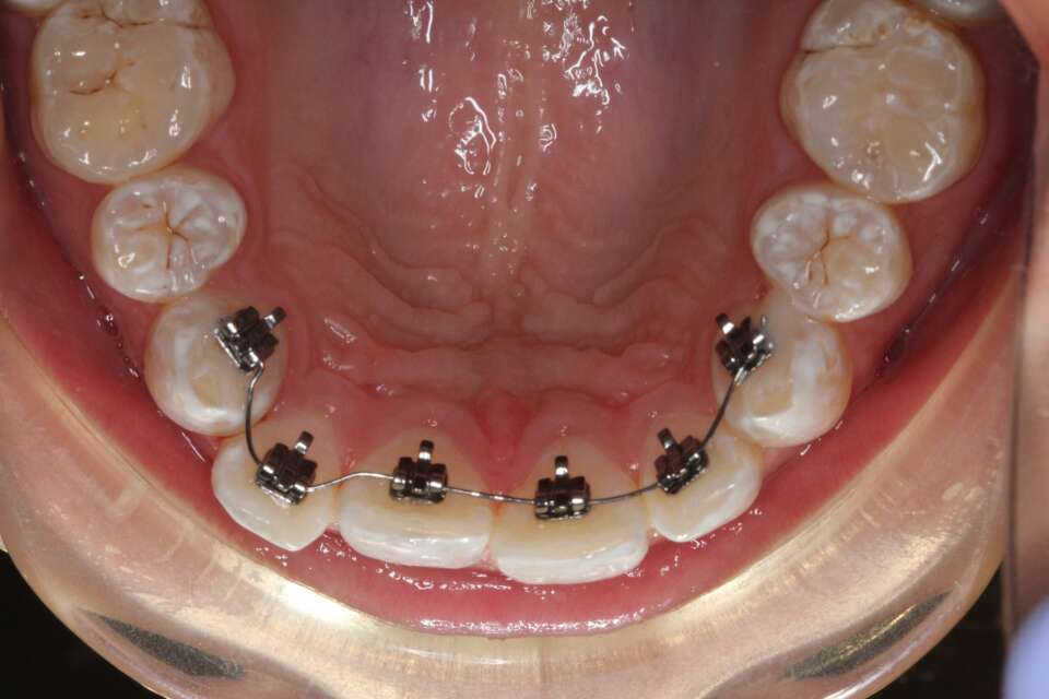 Ceramic Braces